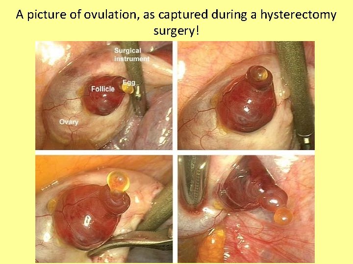 A picture of ovulation, as captured during a hysterectomy surgery! 