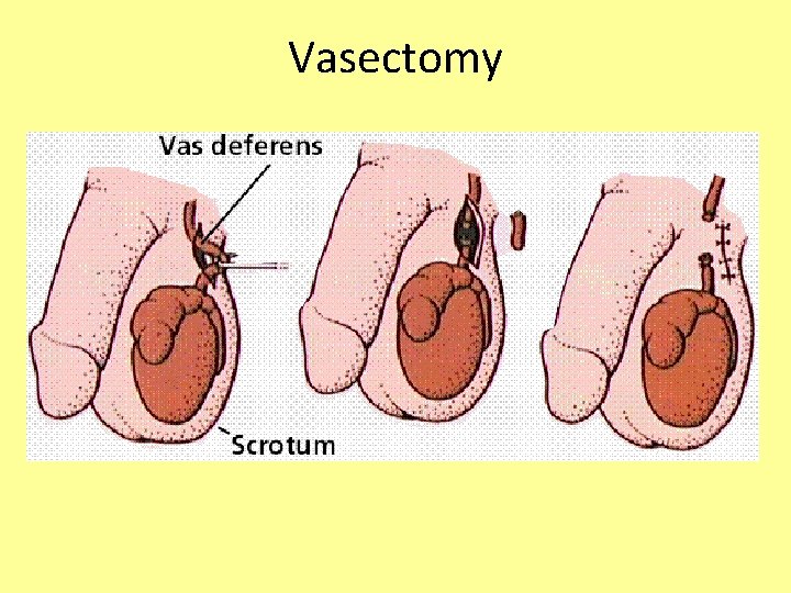 Vasectomy 