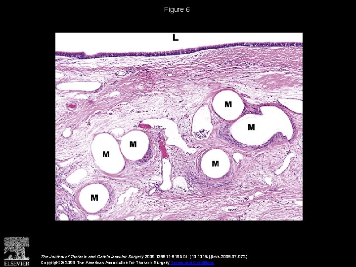 Figure 6 The Journal of Thoracic and Cardiovascular Surgery 2009 138811 -819 DOI: (10.