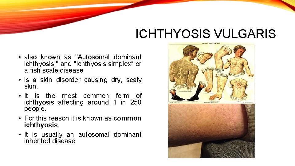 ICHTHYOSIS VULGARIS • also known as "Autosomal dominant ichthyosis, " and "Ichthyosis simplex“ or