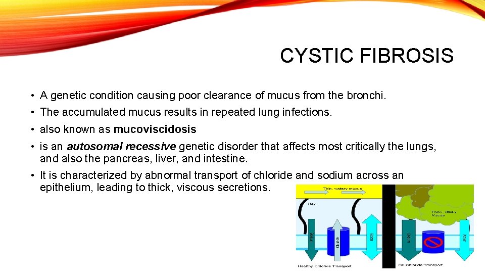 CYSTIC FIBROSIS • A genetic condition causing poor clearance of mucus from the bronchi.