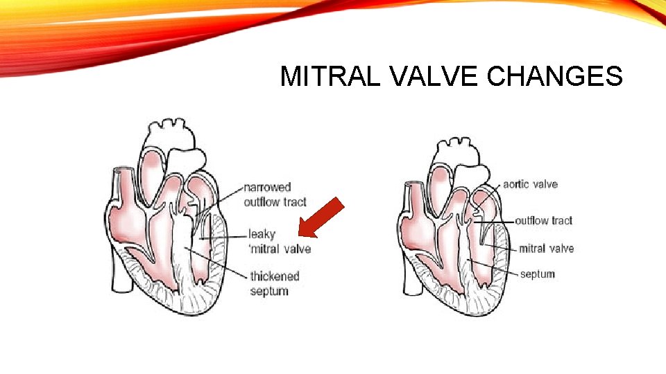 MITRAL VALVE CHANGES 