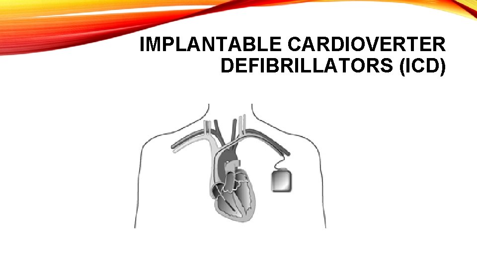 IMPLANTABLE CARDIOVERTER DEFIBRILLATORS (ICD) 