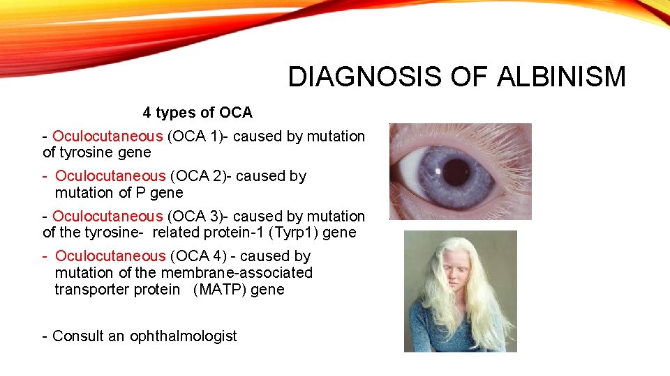 DIAGNOSIS OF ALBINISM 4 types of OCA - Oculocutaneous (OCA 1)- caused by mutation