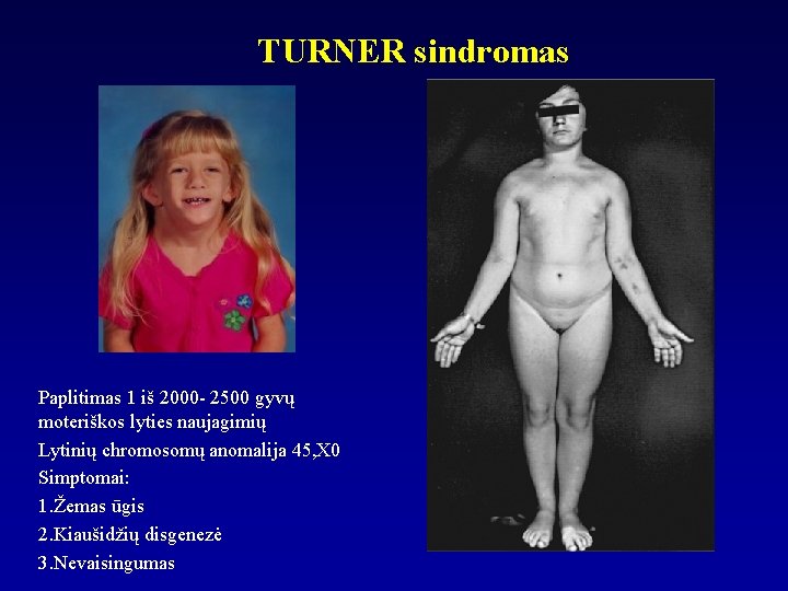 TURNER sindromas Paplitimas 1 iš 2000 - 2500 gyvų moteriškos lyties naujagimių Lytinių chromosomų