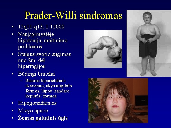 Prader-Willi sindromas • 15 q 11 -q 13, 1: 15000 • Naujagimystėje hipotonija, maitinimo