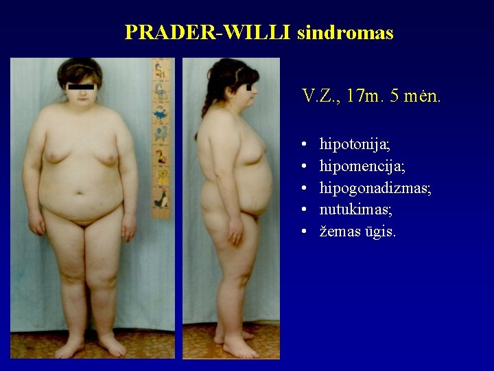 PRADER-WILLI sindromas V. Z. , 17 m. 5 mėn. • • • hipotonija; hipomencija;