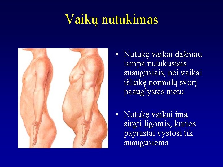 Vaikų nutukimas • Nutukę vaikai dažniau tampa nutukusiais suaugusiais, nei vaikai išlaikę normalų svorį