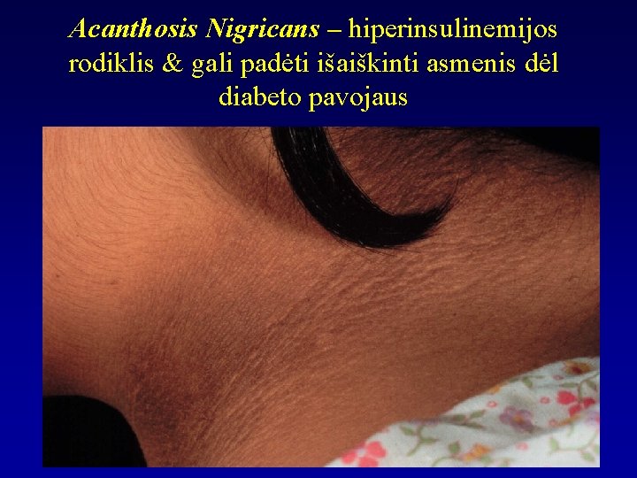Acanthosis Nigricans – hiperinsulinemijos rodiklis & gali padėti išaiškinti asmenis dėl diabeto pavojaus 