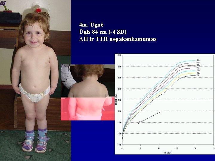 4 m. Ugnė Ūgis 84 cm (-4 SD) AH ir TTH nepakankamumas 