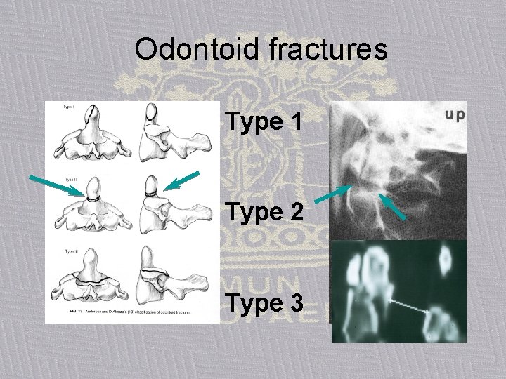 Odontoid fractures Type 1 Type 2 Type 3 