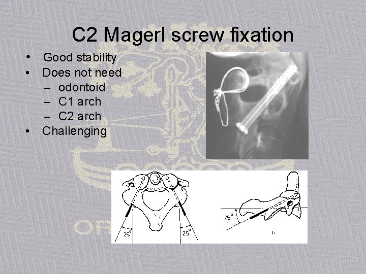 C 2 Magerl screw fixation • Good stability • • Does not need –