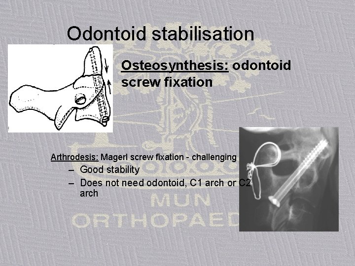 Odontoid stabilisation Osteosynthesis: odontoid screw fixation Arthrodesis: Magerl screw fixation - challenging – Good