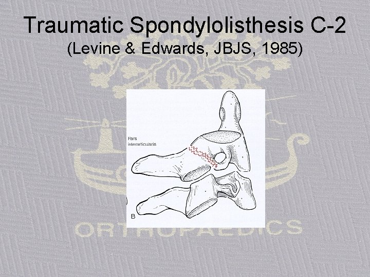 Traumatic Spondylolisthesis C-2 (Levine & Edwards, JBJS, 1985) 