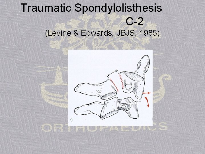 Traumatic Spondylolisthesis C-2 (Levine & Edwards, JBJS, 1985) 