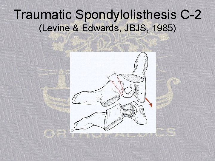 Traumatic Spondylolisthesis C-2 (Levine & Edwards, JBJS, 1985) 