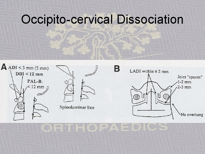 Occipito-cervical Dissociation 