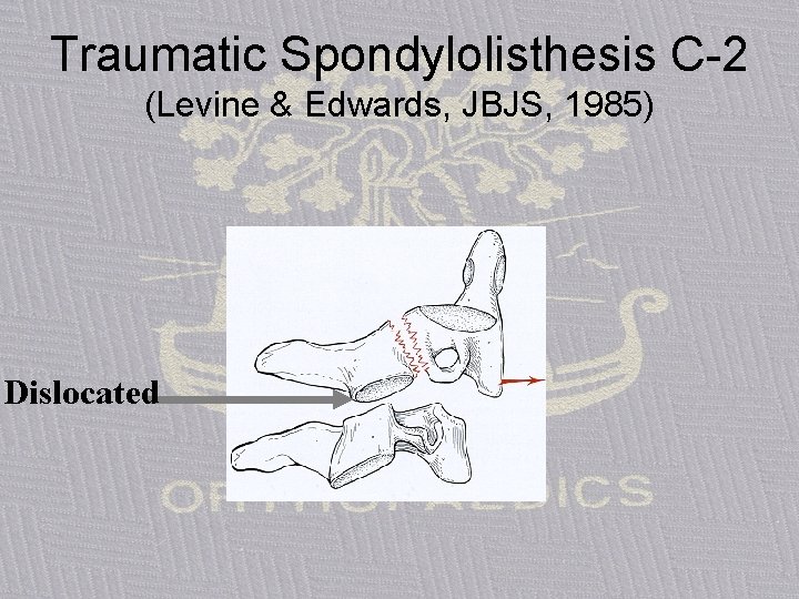 Traumatic Spondylolisthesis C-2 (Levine & Edwards, JBJS, 1985) Dislocated 