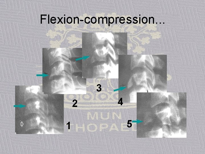 Flexion-compression. . . 3 2 1 4 5 