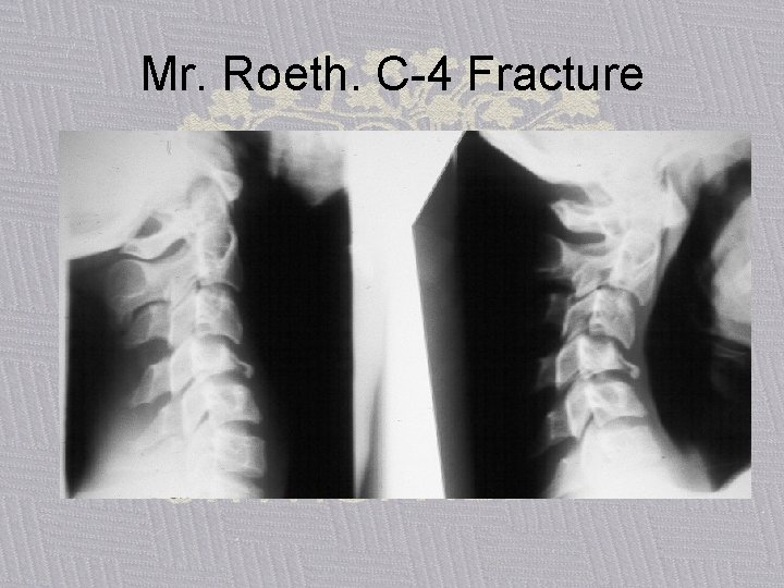 Mr. Roeth. C-4 Fracture 