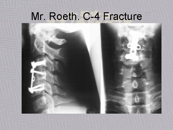 Mr. Roeth. C-4 Fracture 