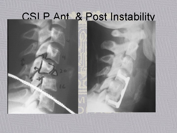 CSLP Ant. & Post Instability 