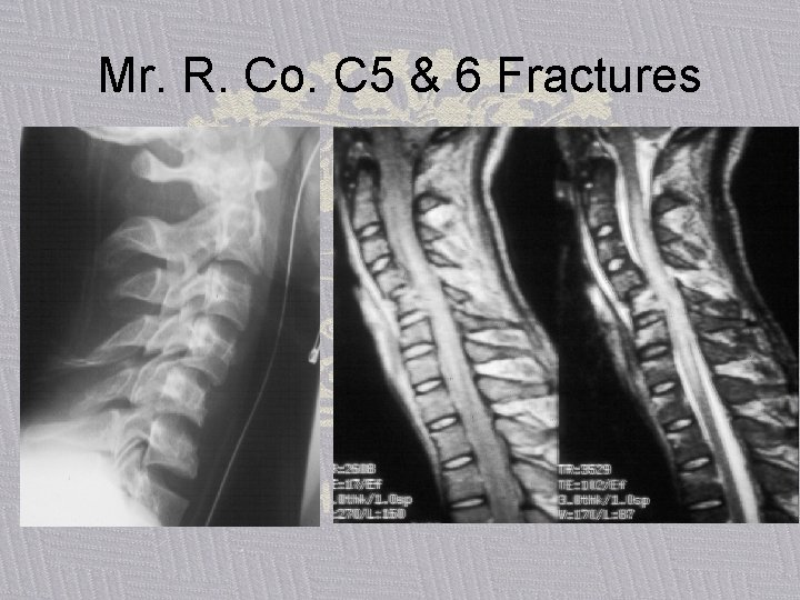 Mr. R. Co. C 5 & 6 Fractures 