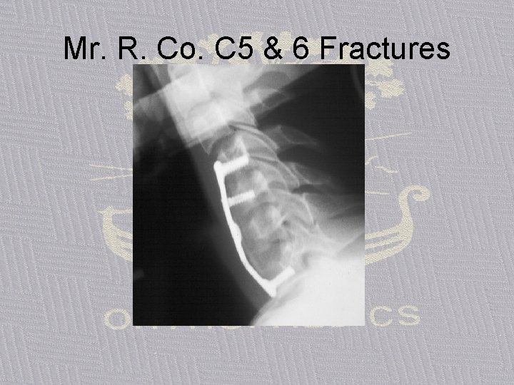 Mr. R. Co. C 5 & 6 Fractures 