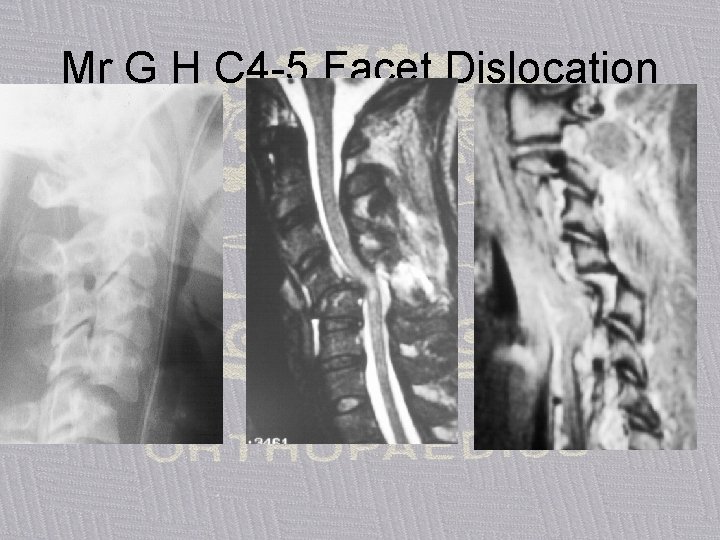 Mr G H C 4 -5 Facet Dislocation 