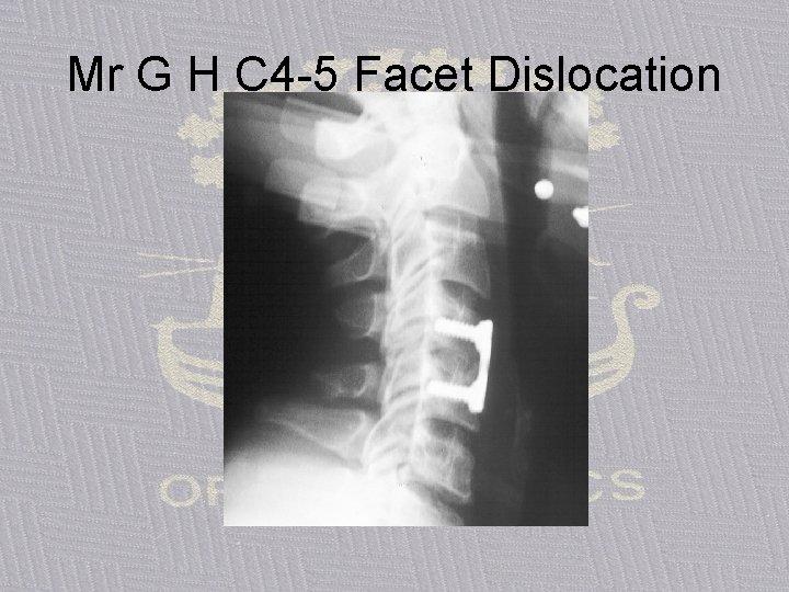 Mr G H C 4 -5 Facet Dislocation 