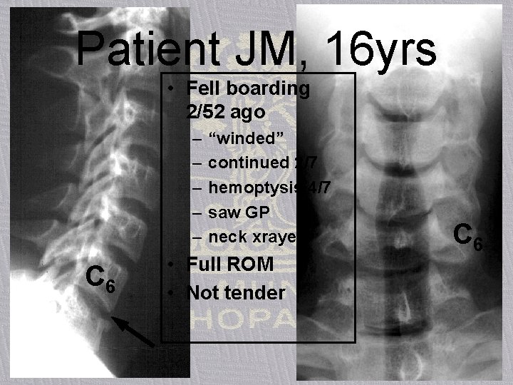 Patient JM, 16 yrs • Fell boarding 2/52 ago – – – C 6