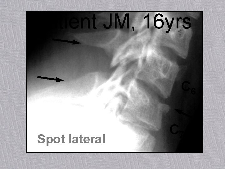 Patient JM, 16 yrs C 6 Spot lateral C 7 