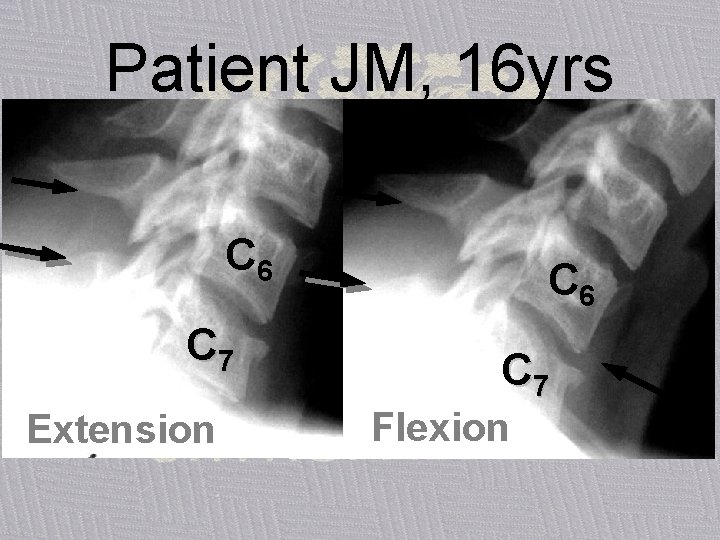 Patient JM, 16 yrs C 6 C 7 Extension C 6 C 7 Flexion