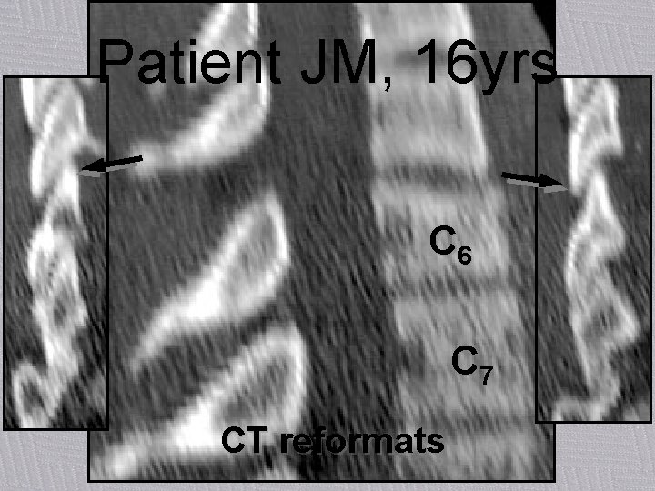 Patient JM, 16 yrs C 6 C 7 CT reformats 