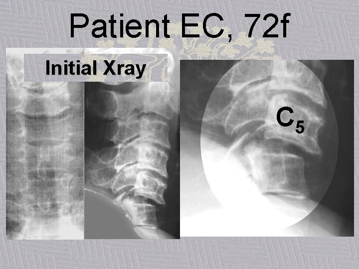 Patient EC, 72 f Initial Xray C 5 