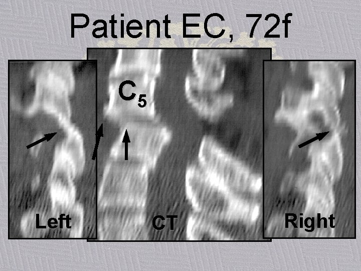Patient EC, 72 f C 5 Left CT Right 