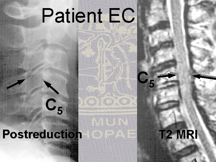 Patient EC, 72 f C 5 Postreduction T 2 MRI 