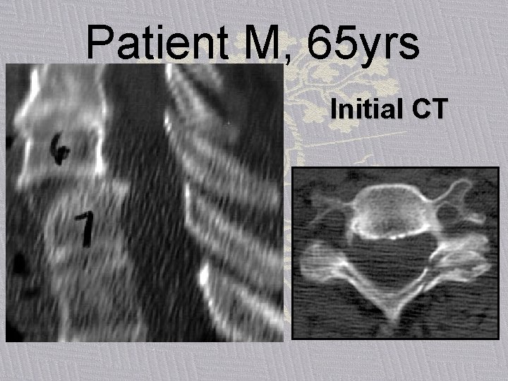 Patient M, 65 yrs Initial CT 