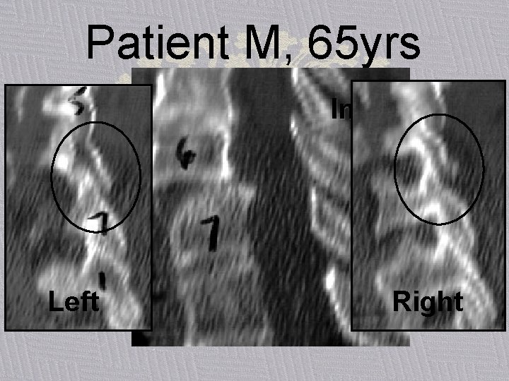 Patient M, 65 yrs Initial CT Left Right 