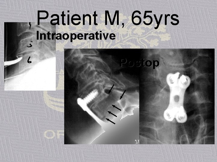 Patient M, 65 yrs Intraoperative Postop 