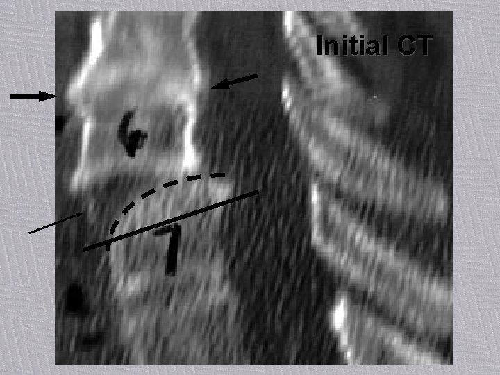 Initial CT Patient M, 65 yrs 