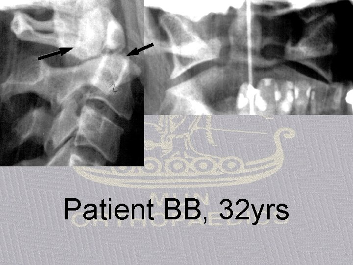 Patient BB, 32 yrs 