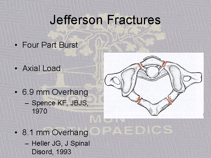 Jefferson Fractures • Four Part Burst • Axial Load • 6. 9 mm Overhang