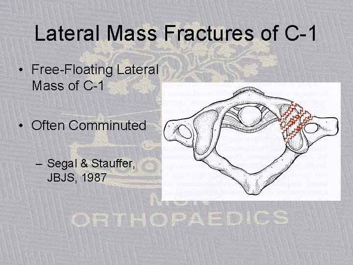 Lateral Mass Fractures of C-1 • Free-Floating Lateral Mass of C-1 • Often Comminuted
