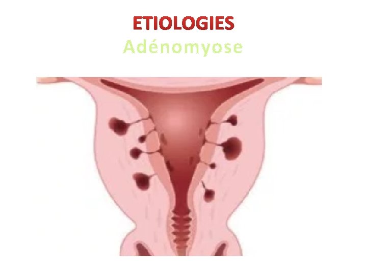 ETIOLOGIES Adénomyose 