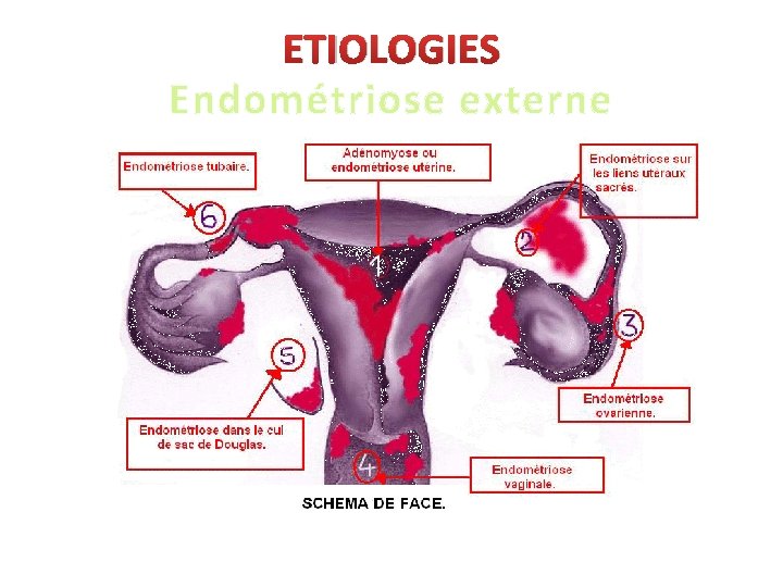 ETIOLOGIES Endométriose externe 