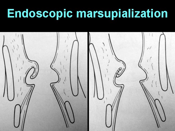 Marspulization Benign Lesions of Larynx Dr Vishal Sharma Common
