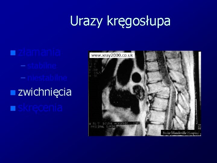 Urazy kręgosłupa n złamania – stabilne – niestabilne n zwichnięcia n skręcenia 