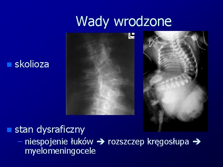 Wady wrodzone n skolioza n stan dysraficzny – niespojenie łuków rozszczep kręgosłupa myelomeningocele 