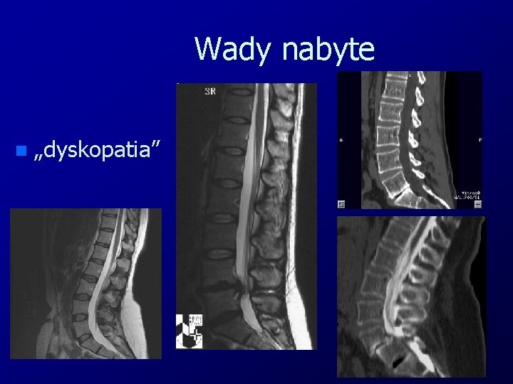 Wady nabyte n „dyskopatia” 